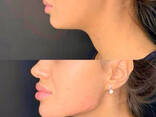 Контурная пластика лица и зоны декольте филлерами мезотерапия - фото 3